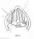 Fig. 24 - Devices and methods for anterior arytenoid adduction