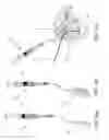 Fig. 25 - Devices and methods for anterior arytenoid adduction