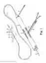 Fig. 02 - Rotational atherectomy device with a system of eccentric abrading heads