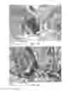 Fig. 07 - Tri-fluted vascular access needle