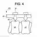 Fig. 04 - Anti-microbial implant