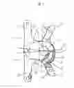 Fig. 10 - Interspinous process spacer implant