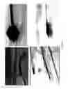 Fig. 19 - System, method and computer-accessible medium for in-vivo tissue ablation and/or damage
