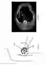Fig. 22 - System, method and computer-accessible medium for in-vivo tissue ablation and/or damage