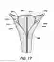 Fig. 18 - Fundus bumper mechanical reference for easier mechanism deployment