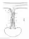 Fig. 04 - Feedback systems and methods for renal denervation utilizing balloon catheter