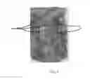 Fig. 02 - DUAL CATHETER ABLATION SYSTEM