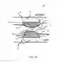 Fig. 15 - DUAL CATHETER ABLATION SYSTEM