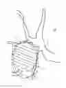 Fig. 08 - System and method for treating COPD and emphysema