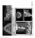 Fig. 10 - Disposable surgical intervention guides, methods, and kits