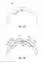Fig. 04 - Dental wire attachment