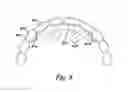 Fig. 07 - Dental wire attachment