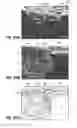 Fig. 34 - SELF-LIGATING ORTHODONTIC BRACKET AND METHOD OF MAKING SAME