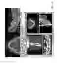Fig. 10 - DISPOSABLE SURGICAL INTERVENTION GUIDES, METHODS, AND KITS