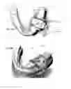 Fig. 22 - DISPOSABLE SURGICAL INTERVENTION GUIDES, METHODS, AND KITS
