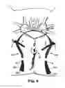Fig. 12 - METHODS AND SYSTEMS FOR TREATMENT OF PROLAPSE