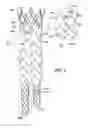 Fig. 02 - Circular Sectional Inserts For Insertion with a Trunk Section in Endoprosthesis for Aortic Aneurysm