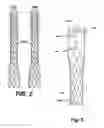 Fig. 04 - Circular Sectional Inserts For Insertion with a Trunk Section in Endoprosthesis for Aortic Aneurysm