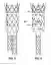 Fig. 07 - Circular Sectional Inserts For Insertion with a Trunk Section in Endoprosthesis for Aortic Aneurysm