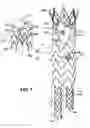 Fig. 02 - Sectional Inserts for Trunk Section in Endoprosthesis for Aortic Aneurysm