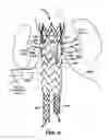 Fig. 04 - Sectional Inserts for Trunk Section in Endoprosthesis for Aortic Aneurysm