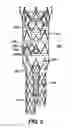 Fig. 05 - Sectional Inserts for Trunk Section in Endoprosthesis for Aortic Aneurysm