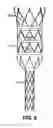 Fig. 06 - Sectional Inserts for Trunk Section in Endoprosthesis for Aortic Aneurysm