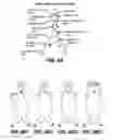 Fig. 08 - Sectional Inserts for Trunk Section in Endoprosthesis for Aortic Aneurysm