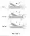 Fig. 07 - Graft with expandable region and methods of making and using the same