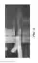 Fig. 16 - Graft with expandable region and methods of making and using the same