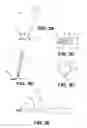 Fig. 04 - Corneal implant retaining devices and methods of use