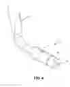 Fig. 07 - Corneal implant retaining devices and methods of use