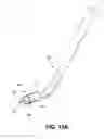 Fig. 17 - Corneal implant retaining devices and methods of use
