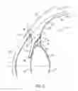 Fig. 03 - Ocular collar stent for treating narrowing of the irideocorneal angle