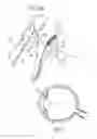 Fig. 04 - Ocular collar stent for treating narrowing of the irideocorneal angle