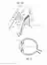Fig. 06 - Ocular collar stent for treating narrowing of the irideocorneal angle