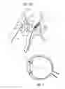 Fig. 08 - Ocular collar stent for treating narrowing of the irideocorneal angle