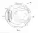 Fig. 05 - Systems and methods for implanting and examining intraocular lens