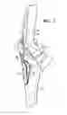 Fig. 10 - ORTHOPEDIC IMPLANTS