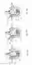 Fig. 14 - ARTIFICIAL HIP JOINT REPLACEMENT SYSTEM