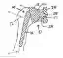 Fig. 01 - Method for Optimization of Joint Arthroplasty Component Design