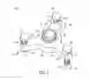 Fig. 06 - Prosthesis alignment system