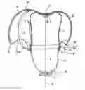 Fig. 01 - Prosthesis socket with insertion aid