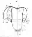 Fig. 04 - Prosthesis socket with insertion aid