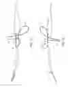 Fig. 03 - Trigger wire arrangements for endografts