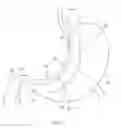 Fig. 08 - Method for performing a gastrectomy