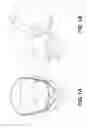 Fig. 02 - External Mandibular Advancement Splint