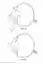 Fig. 12 - Capsular membrane treatments to increase accommodative amplitude