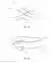 Fig. 10 - Reduced pressure therapy of the sacral region