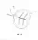 Fig. 20 - Reduced pressure therapy of the sacral region